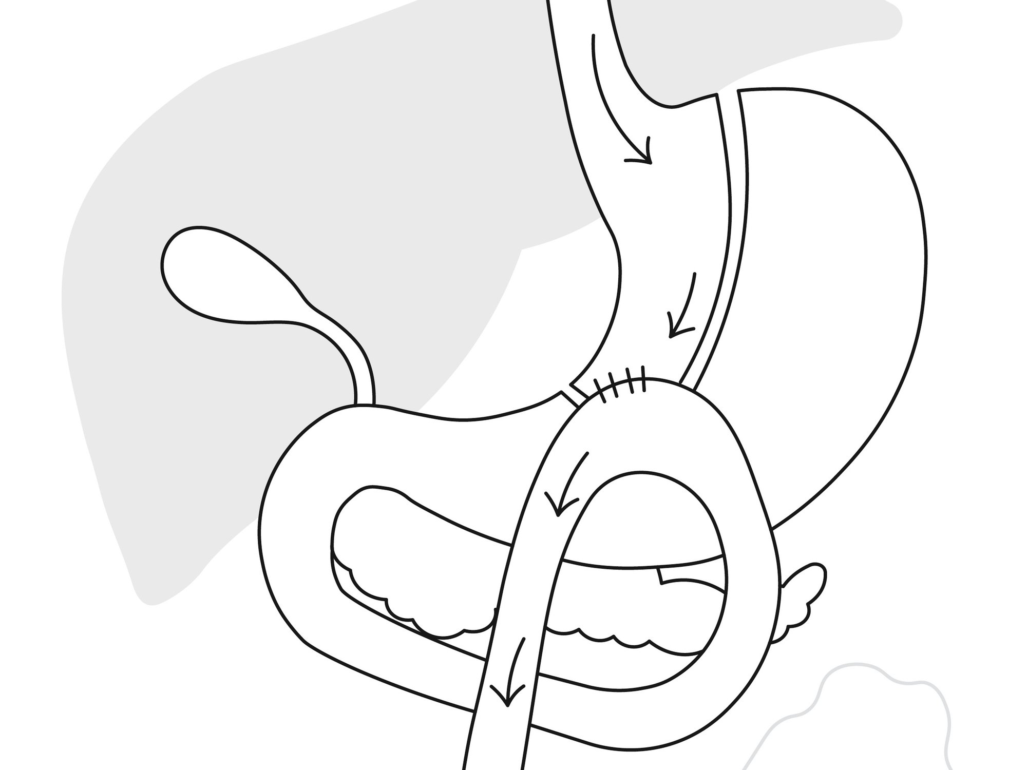 Na een Mini Gastric Bypass heb je een kleinere maag