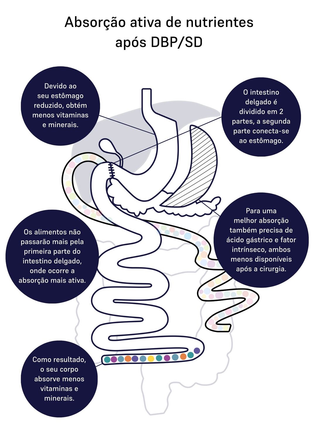 Image of absorption of nutrients for duodenal switch 
