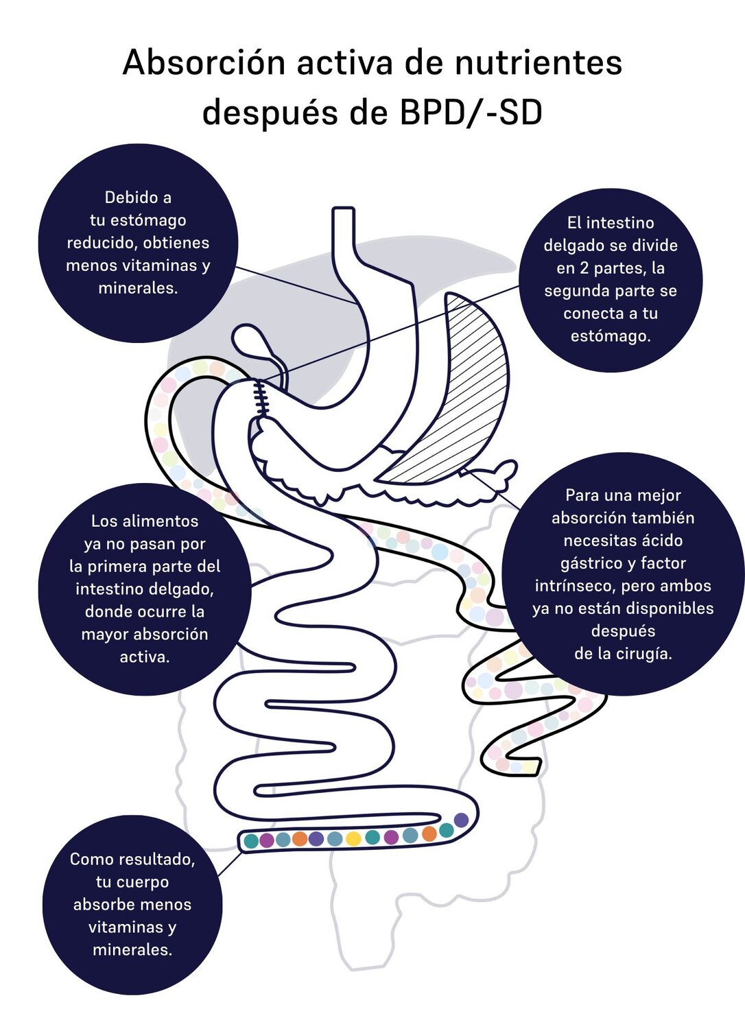 Image of absorption of nutrients for duodenal switch 