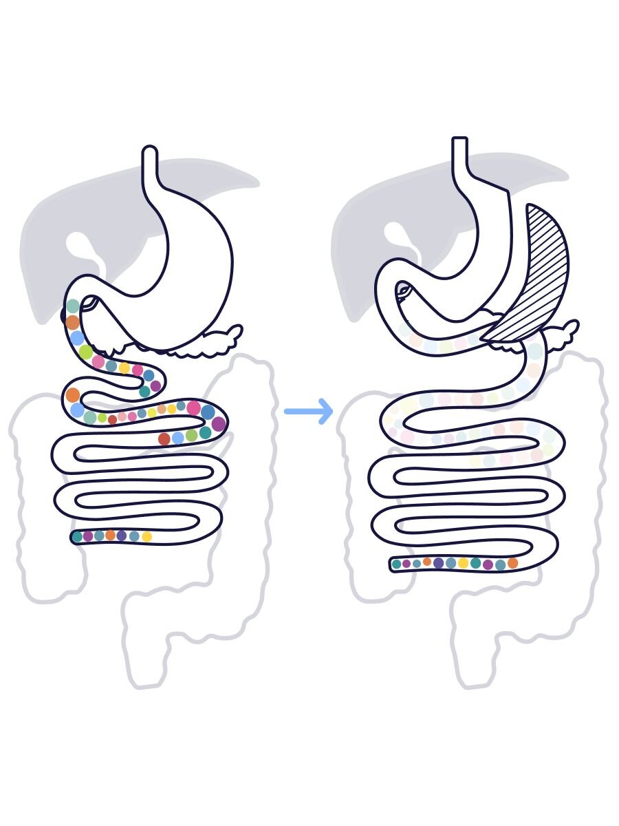 Before and After Gastric Sleeve