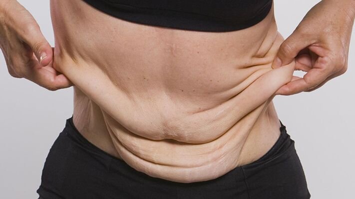 Excess skin