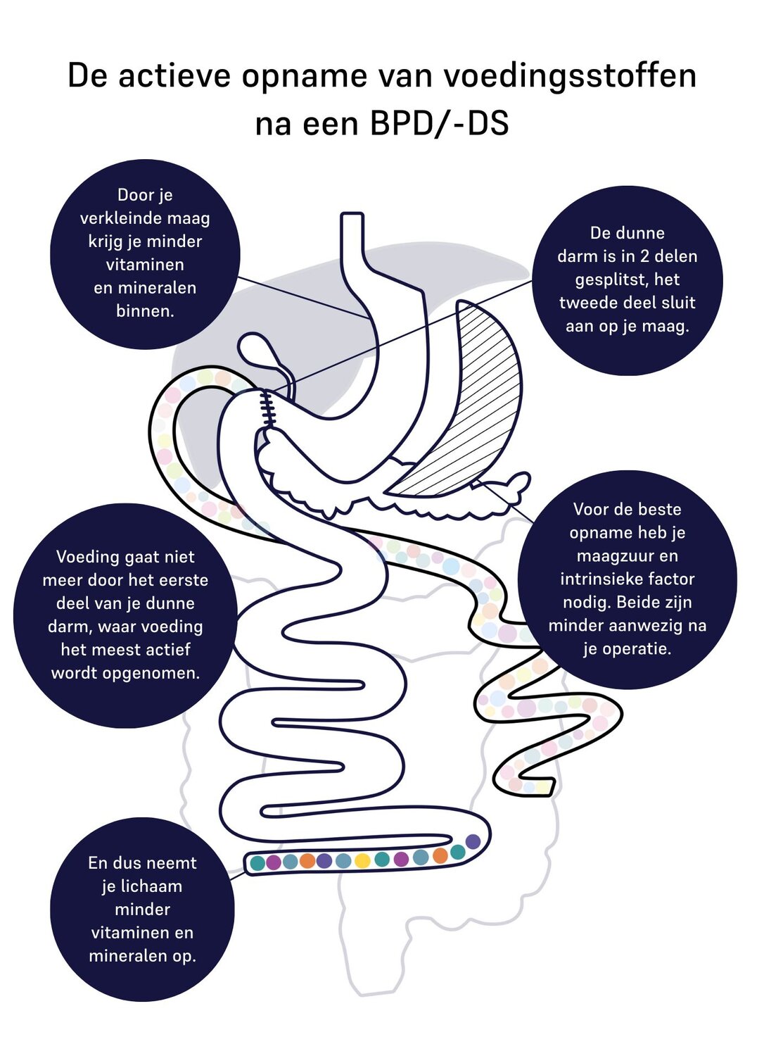 Image of absorption of nutrients for duodenal switch 