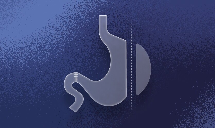 WLS Maximum, Multivitamin für Biliopankreatische Diversion-/ Duodenal Switch