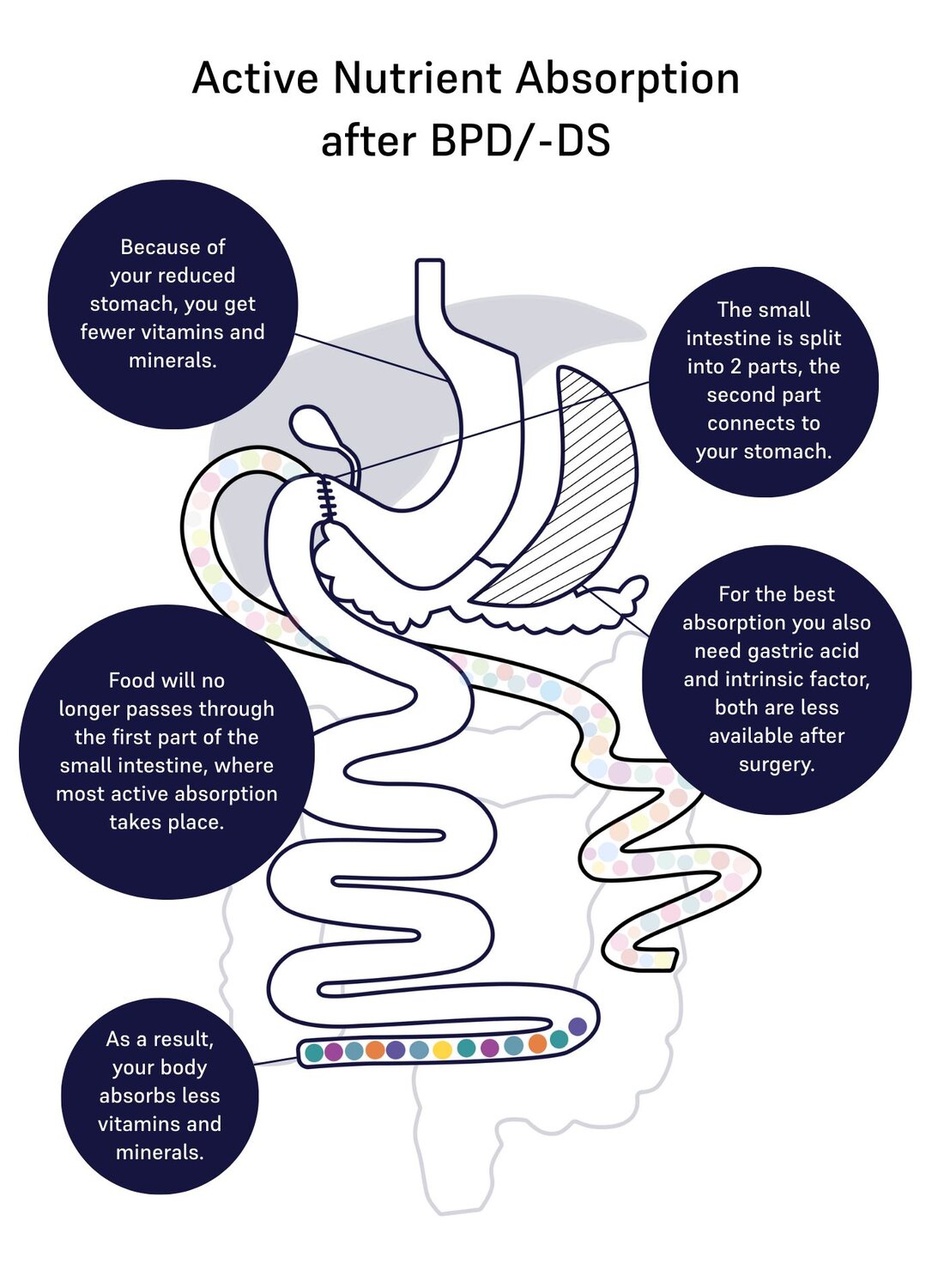 Image of absorption of nutrients for duodenal switch 