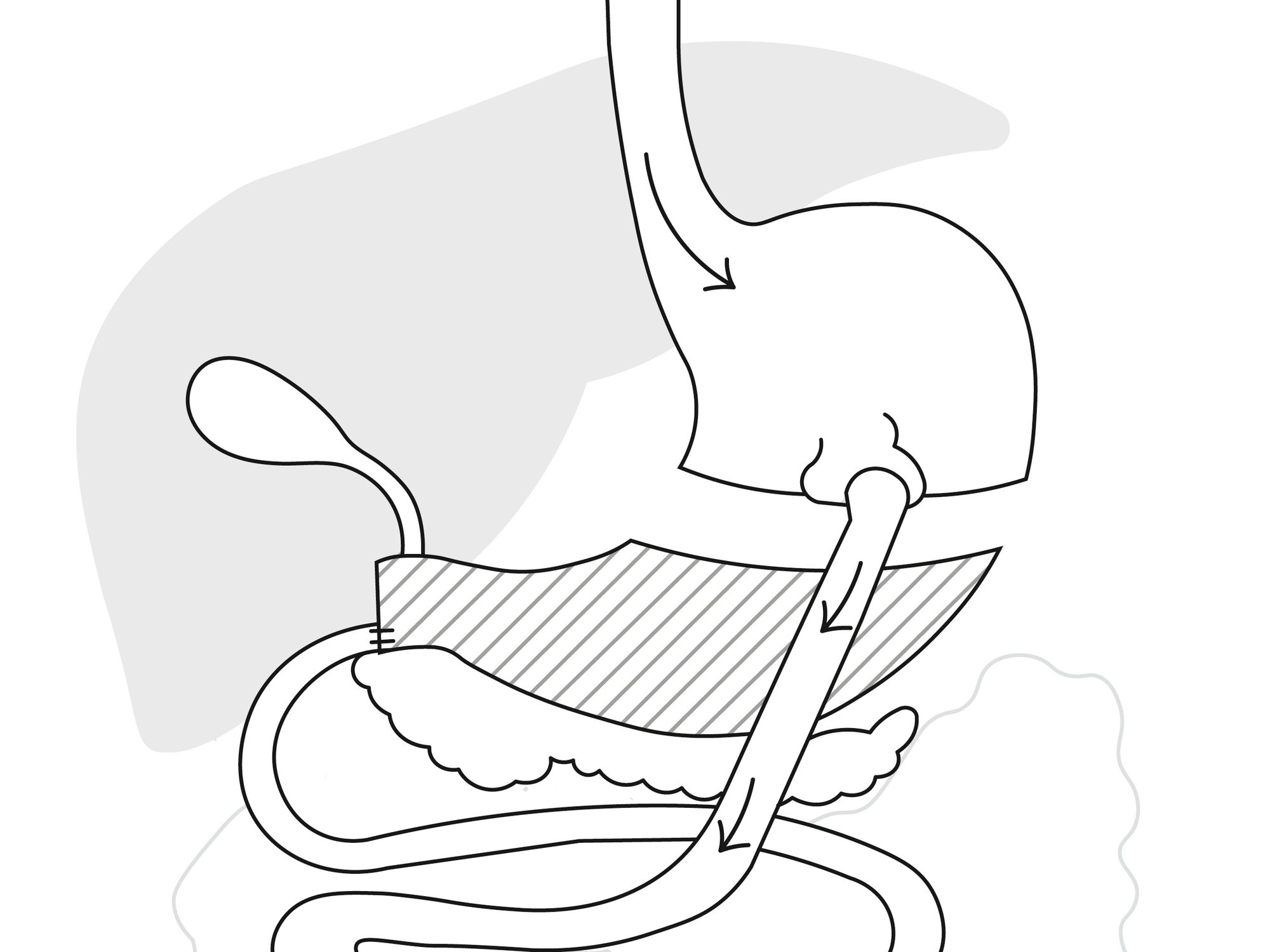 After a Biliopancreatic Diversion, your stomach is smaller