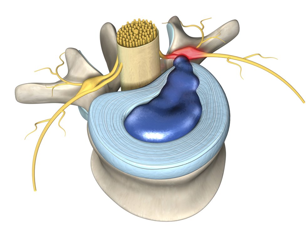 Diagram illustration of a herniated disc