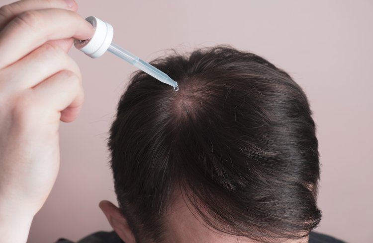 Man applying Minoxidil treatment to his scalp
