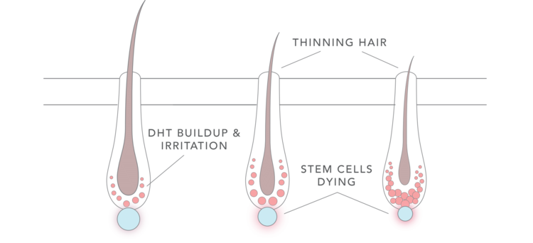 Graphic showing the process of DHT Buildup and irritation that leads to thinning hair