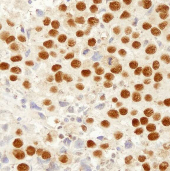 Immunohistochemistry image showing strong brown nuclear staining across cells in a tissue section