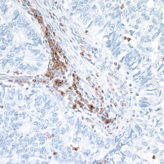 Immunohistochemistry showing brown-stained immune cell infiltration within light blue tumor tissue background