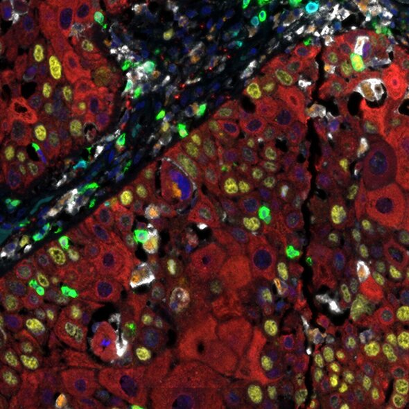 Fluorescence microscopy image of tissue showing red background with green, yellow, blue, and white stained cells