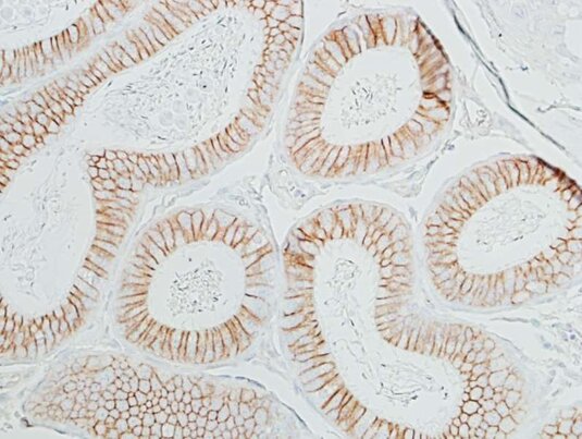Detection of mouse beta Catenin (brown) in FFPE plasmacytoma by IHC.