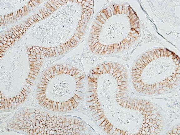Immunohistochemistry image showing glandular epithelial cells with strong brown membrane staining highlighting cell borders.