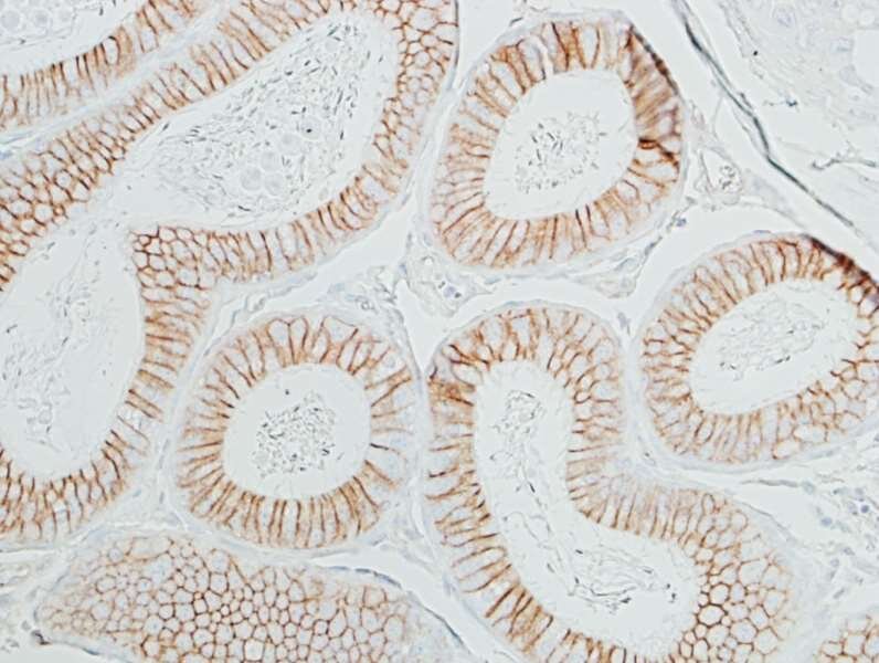 Detection of mouse beta Catenin (brown) in FFPE plasmacytoma by IHC.