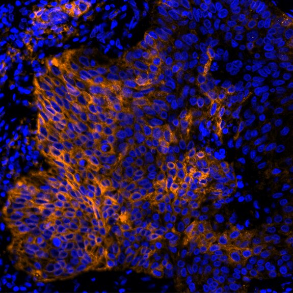 Detection of human PD-L1 (orange) in FFPE lung carcinoma by IHC-IF (pseudo color)