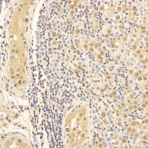 Immunohistochemistry image showing brown-stained positive cells among blue-stained nuclei in tissue section