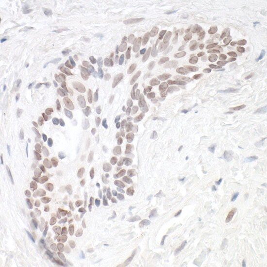Immunohistochemistry image showing nuclear protein expression in clustered epithelial cells within tissue section.