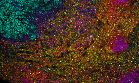 AX LN Adenocarcinoma - Lunaphore COMET™