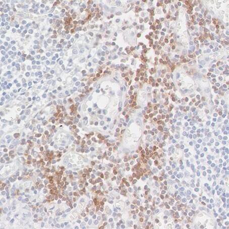 Microscopy image showing brown-stained cells among blue-stained nuclei in immunohistochemistry tissue sample - Detection of CD247/CD3Z in a FFPE section of metastatic lymph node from lung cancer origin by IHC