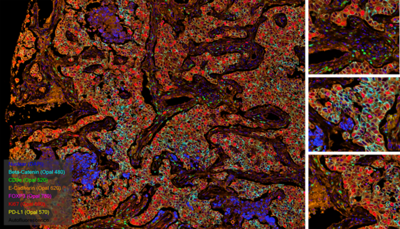 Multiplex immunofluorescence image showing tumor tissue stained for Beta-Catenin, CD8α, E-Cadherin, FOXP3, Ki67, and PD-L1