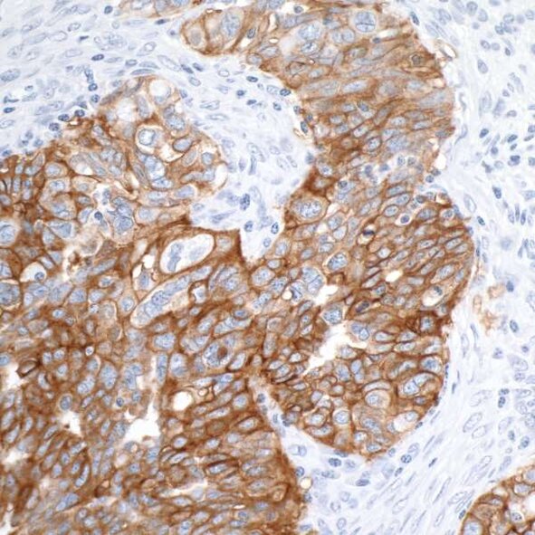Immunohistochemistry image showing strong brown membrane staining of tumor cells with blue-stained nuclei