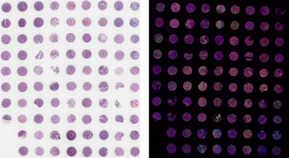 Tissue microarray image showing multiple circular tissue samples in brightfield (left) and fluorescence (right).