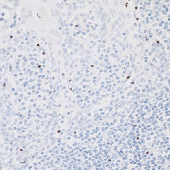 IHC staining showing scattered brown nuclear FOXP3-positive cells among predominantly blue counterstained cells.