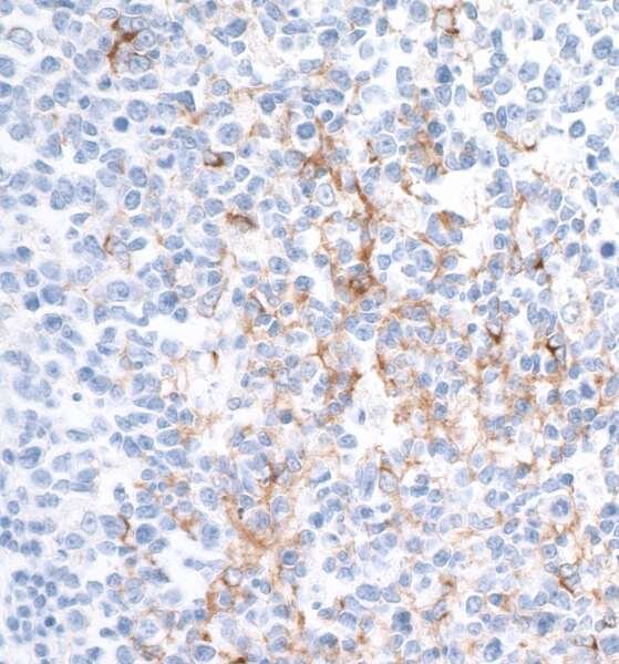 IHC staining of tissue showing brown marker expression in select cells among mostly blue-stained nuclei