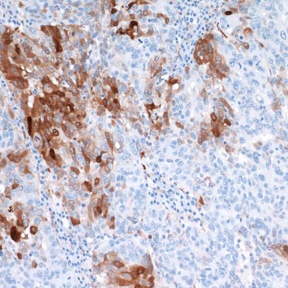 IHC staining of human tissue showing strong brown cytoplasmic positivity in clusters, with blue counterstained nuclei.