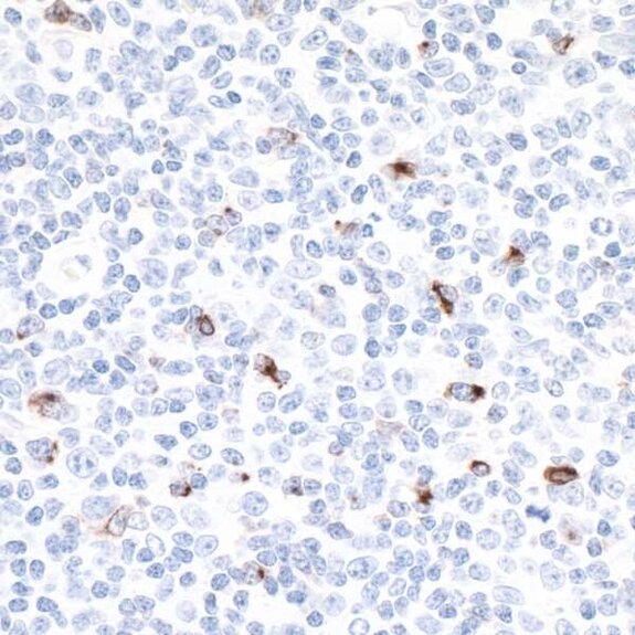 IHC staining showing scattered brown-positive cells among predominantly blue-stained nuclei in tissue section