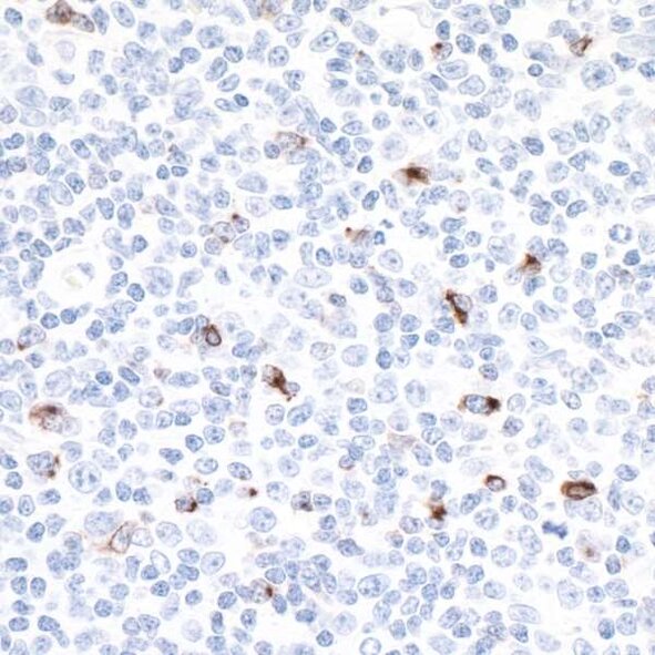 IHC staining showing scattered brown-positive cells among predominantly blue-stained nuclei in tissue section