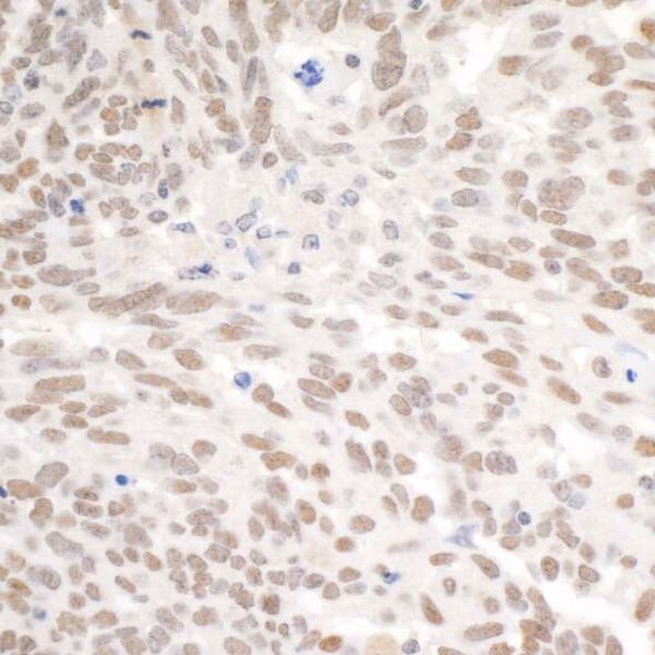 Immunohistochemistry image showing brown nuclear staining of protein expression in tissue section