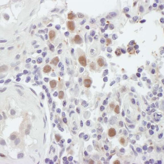Immunohistochemistry tissue image showing brown-stained positive cells among blue-stained nuclei