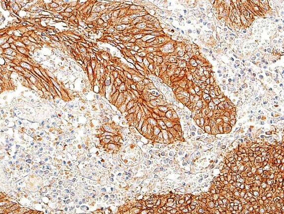 Immunohistochemistry image showing strong brown membrane staining in tumor cells, highlighting epithelial cancer tissue.