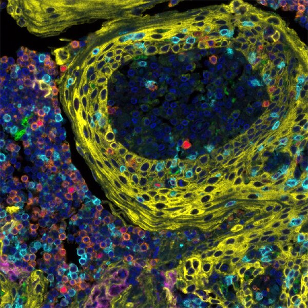 Tumor tissue cross-section showing a blood vessel with fibrous yellow walls and cells labeled blue, cyan, orange, and purple.