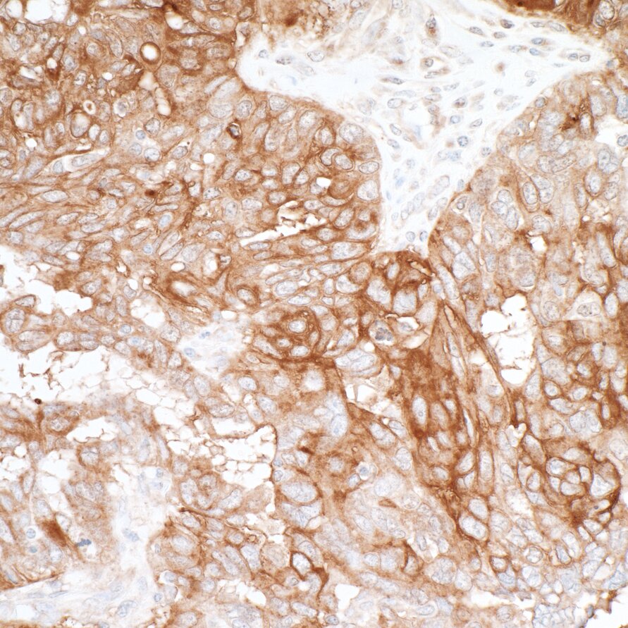Immunohistochemistry image showing brown staining of protein expression in tissue, highlighting cellular structures and morphology.