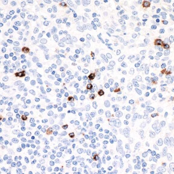 IHC image showing scattered brown-stained cells among predominantly blue-stained nuclei in tissue section
