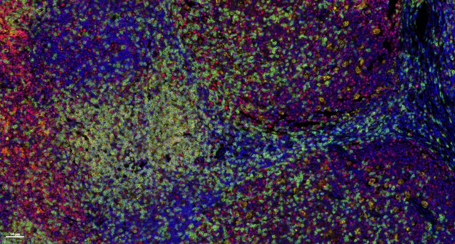 Multiplex image showing CD3e, CD8a, PD-L1, and CD68.