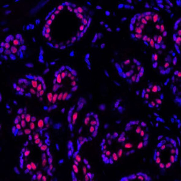 Fluorescence microscopy image of tissue with nuclei stained blue and target protein stained red in clustered cells