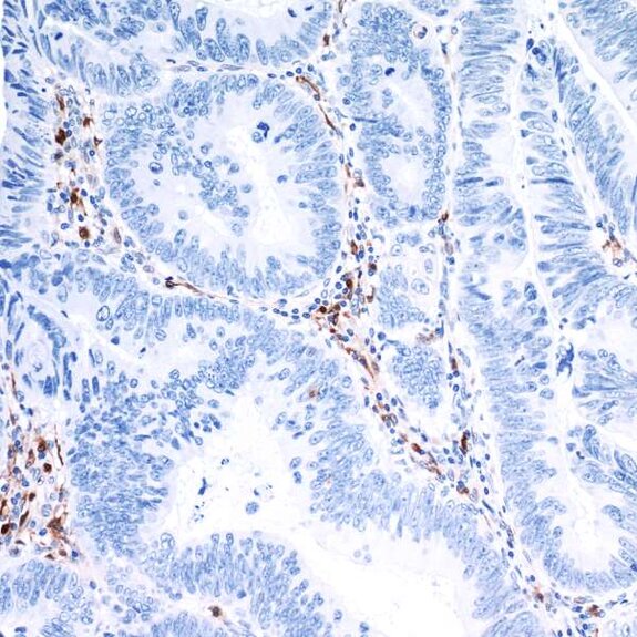 IHC staining of human tissue showing scattered brown-stained positive cells among predominantly blue-stained nuclei.