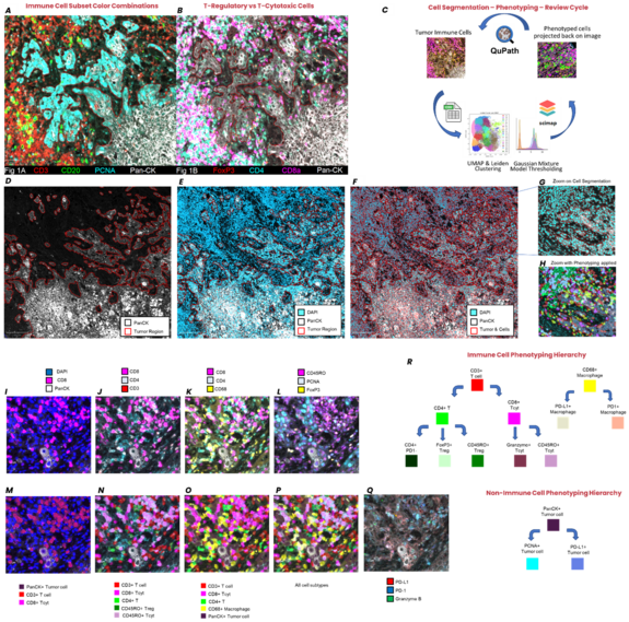 Multiplex IF tumor panels with QuPath segmentation workflow and immune cell phenotyping maps