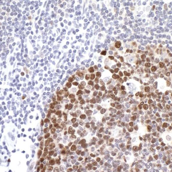 IHC image showing strong brown nuclear staining in clustered cells with surrounding negative blue-stained cells