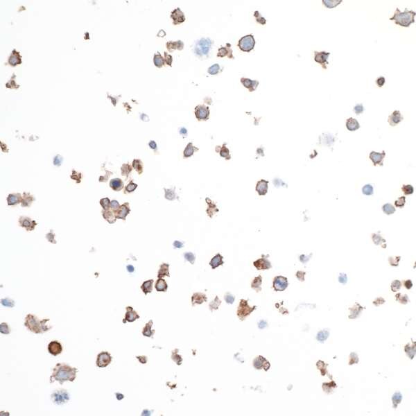 IHC staining of scattered cells showing brown positive marker expression with blue counterstained nuclei