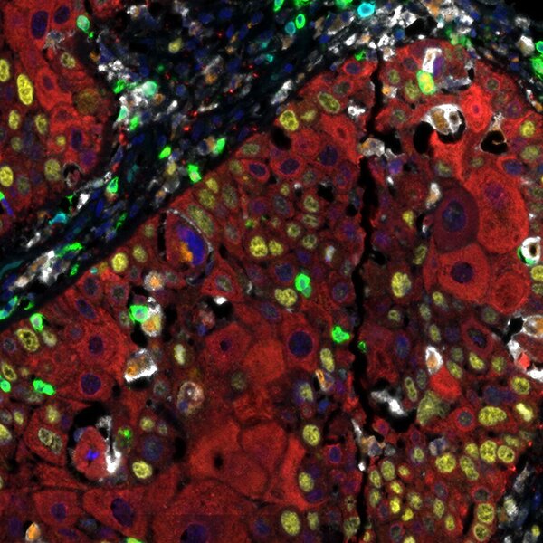 Fluorescence microscopy image of tissue showing nuclei in blue, cytoplasm in red, and protein markers in green, yellow, and white.