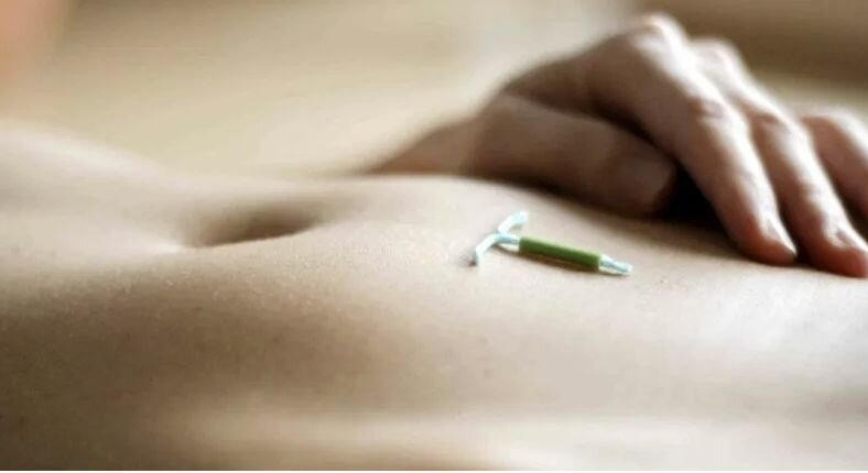 COLOCACIÓN O REVISIÓN DE DIU