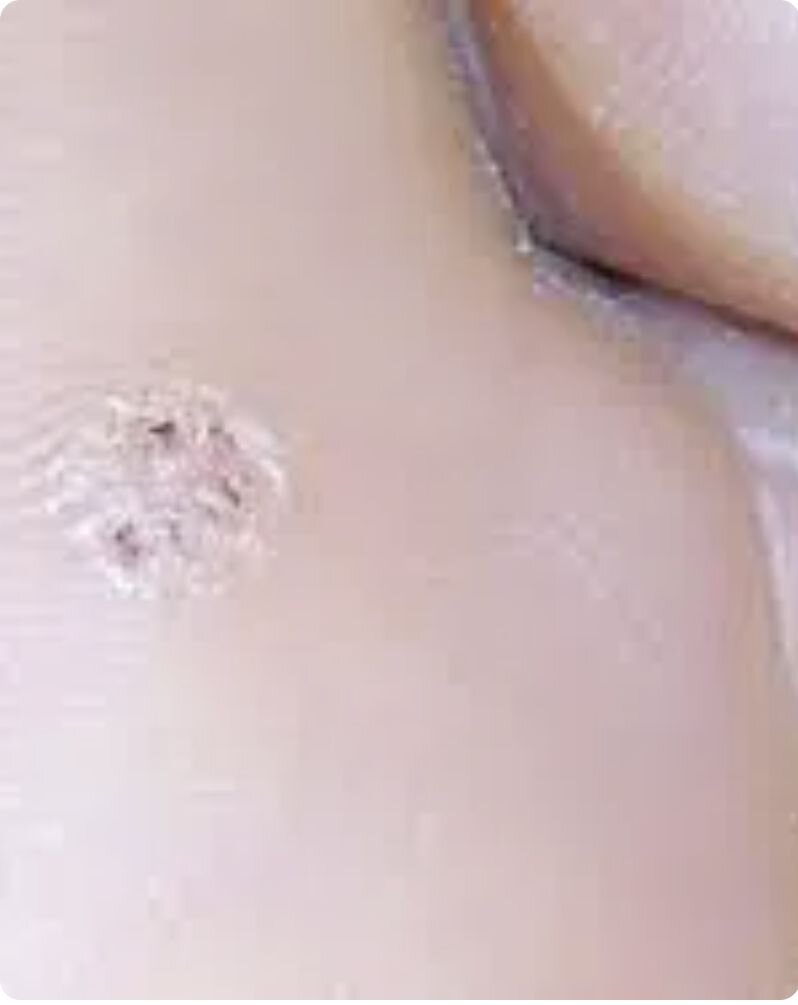 VIRUS PAPILOMA HUMANO