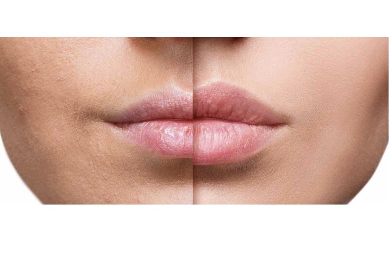AUMENTO DE LABIOS