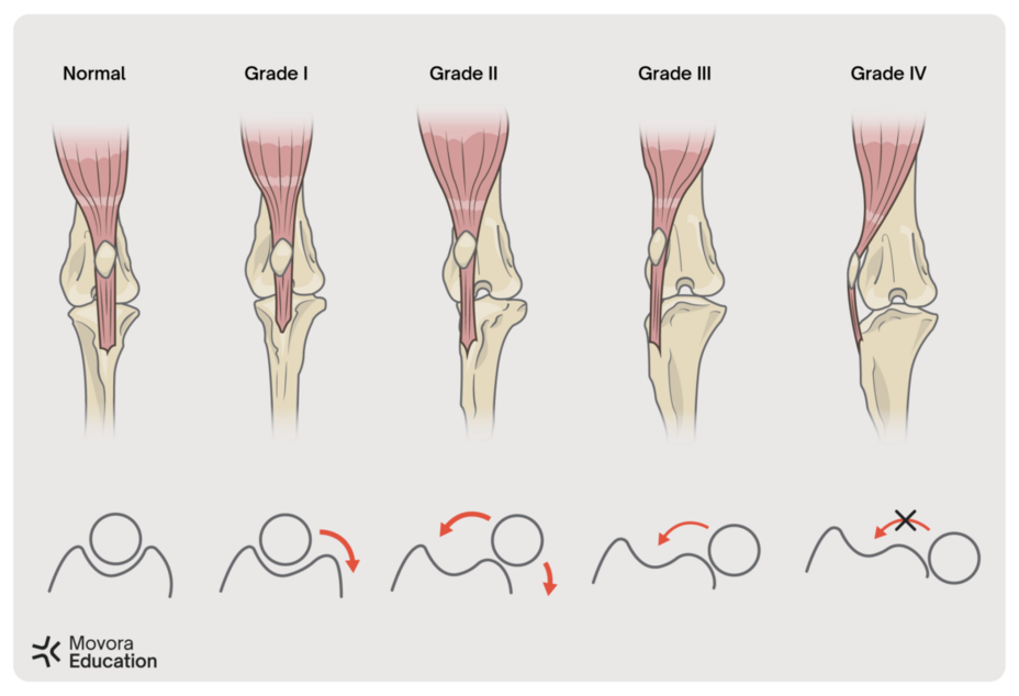 Grading of Medial Patellar Luxation