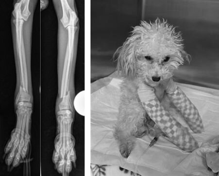 X-ray of Sprig's bilateral radioulnar fractures before surgery and post-op