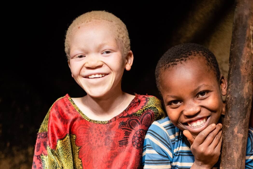 What is Albinism? Five Things You Should Know